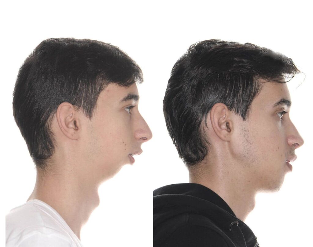 📝 Cirugía de Mentón: 5 Mitos que te están confundiendo 😱💉 (Y la verdad que nadie te dice)